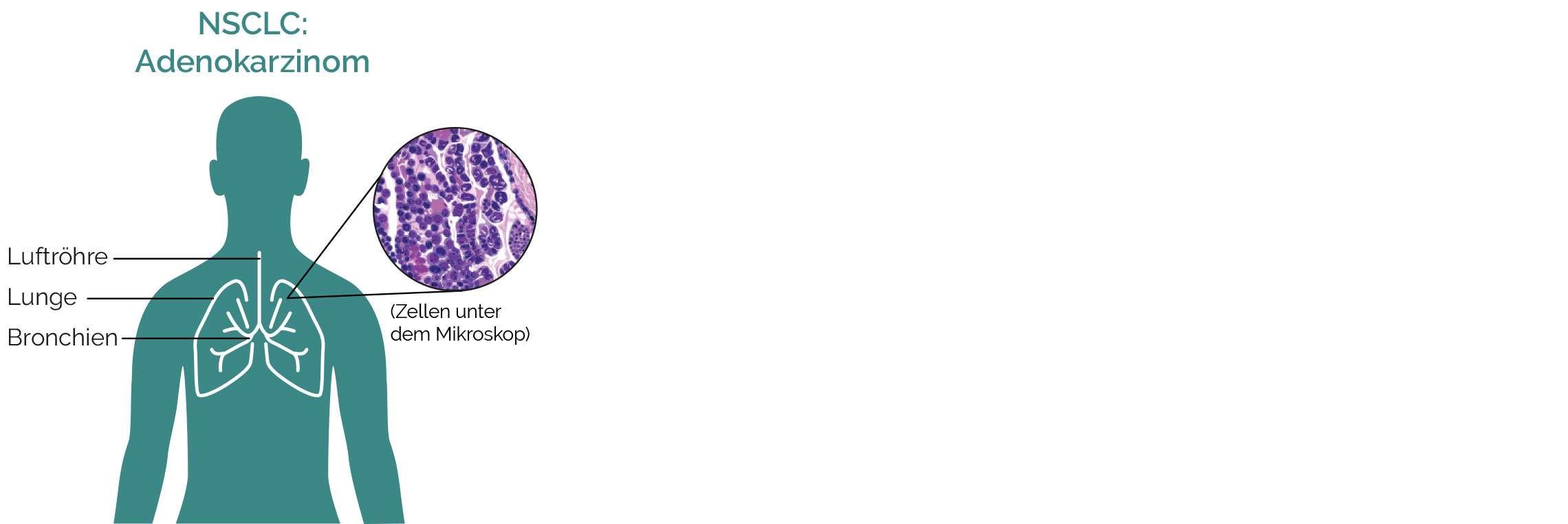 NSCLC Adenokarzinom