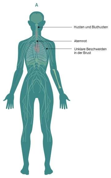 Lungenkrebs Verstehen De Lungenkrebs Symptome Sind Husten Brustschmerzen Atemnot