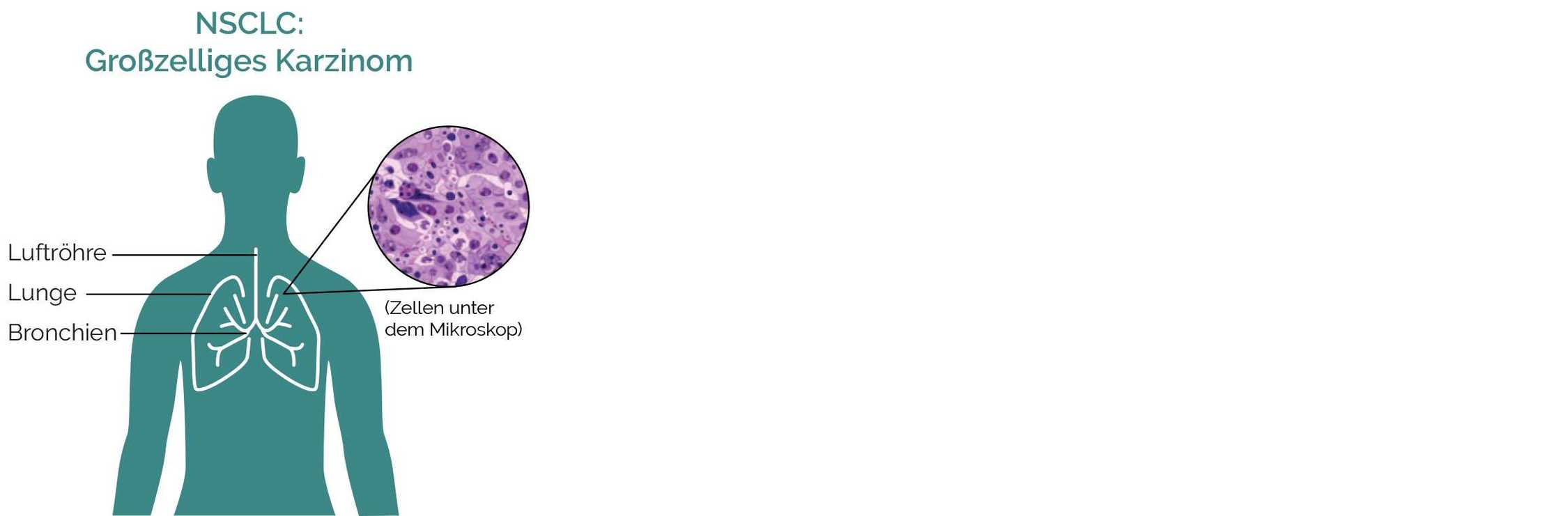 NSCLC Großzelliges Karzinom