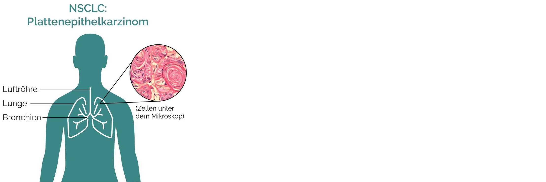 NSCLC Plattenpithelkarzinom