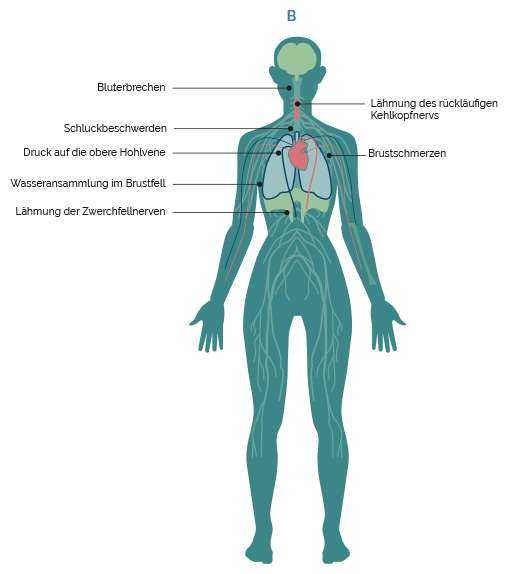 Grafik Beschwerden durch Ausgangtumor 2